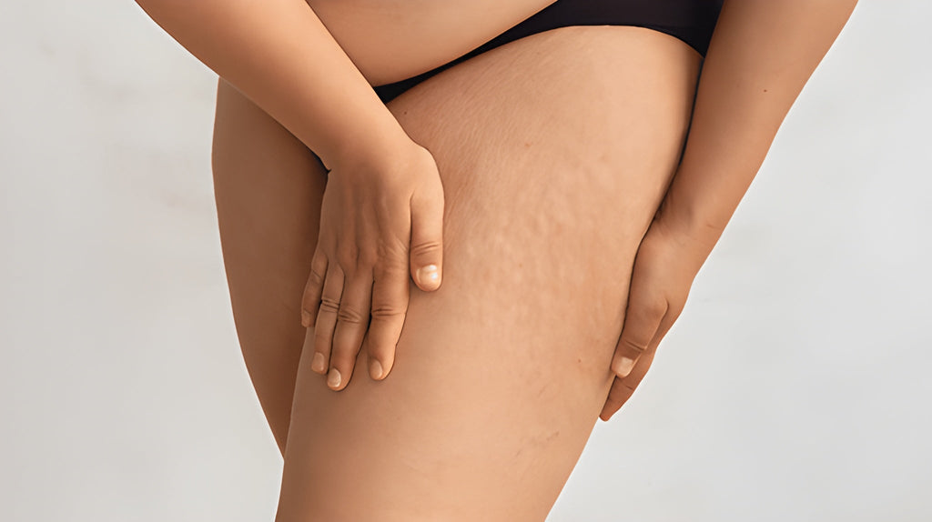 Cellulit – skuteczne metody walki i zapobieganie jego powstawaniu