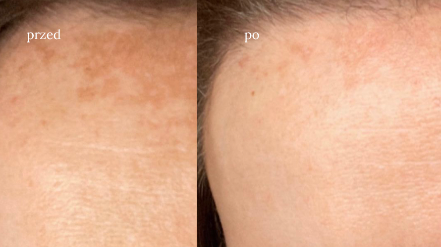 Przebarwienia skóry – zapobieganie i skuteczne sposoby ich redukcji