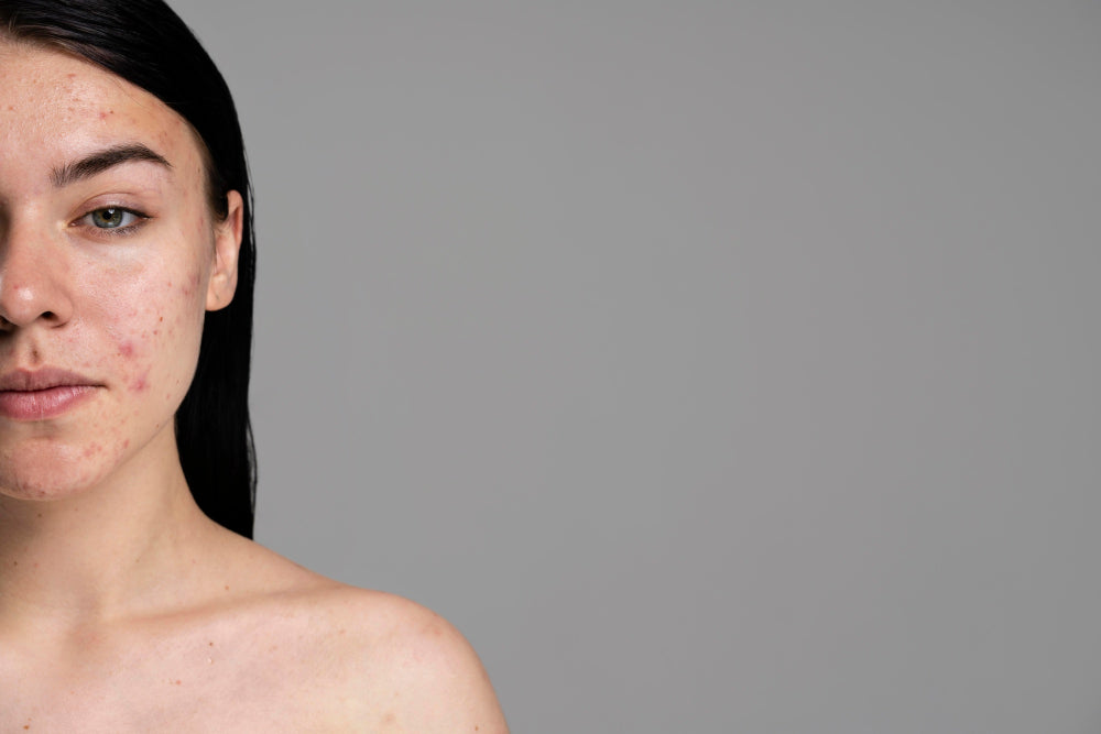 Trądzik neuropatyczny – czym jest i jak go leczyć?