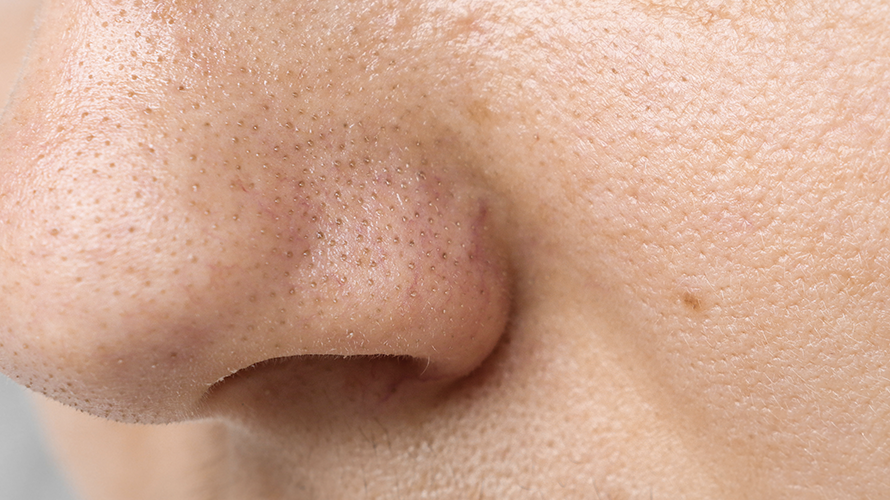 Zaskórniki otwarte – przyczyny, pielęgnacja i zapobieganie